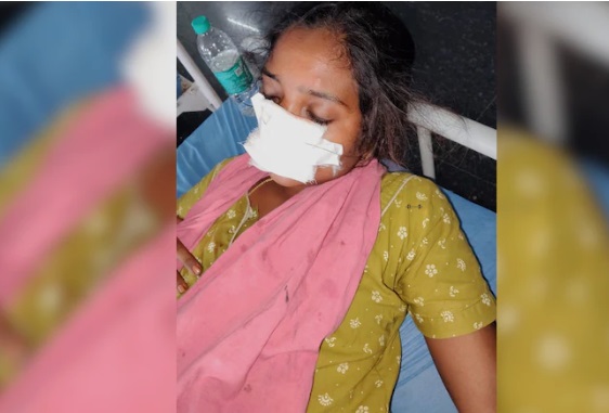 இந்தியா தெலங்கானா மாநிலம் மஞ்சேரியால் மாவட்டத்தில் உள்ள கோட்டபல்லி மண்டலத்தில், குடும்பத் தகராறு காரணமாக மனைவியின் மூக்கைக் கணவன் கடித்துக் குதறிய அதிர்ச்சிச் சம்பவம் இடம்பெற்றுள்ளது.